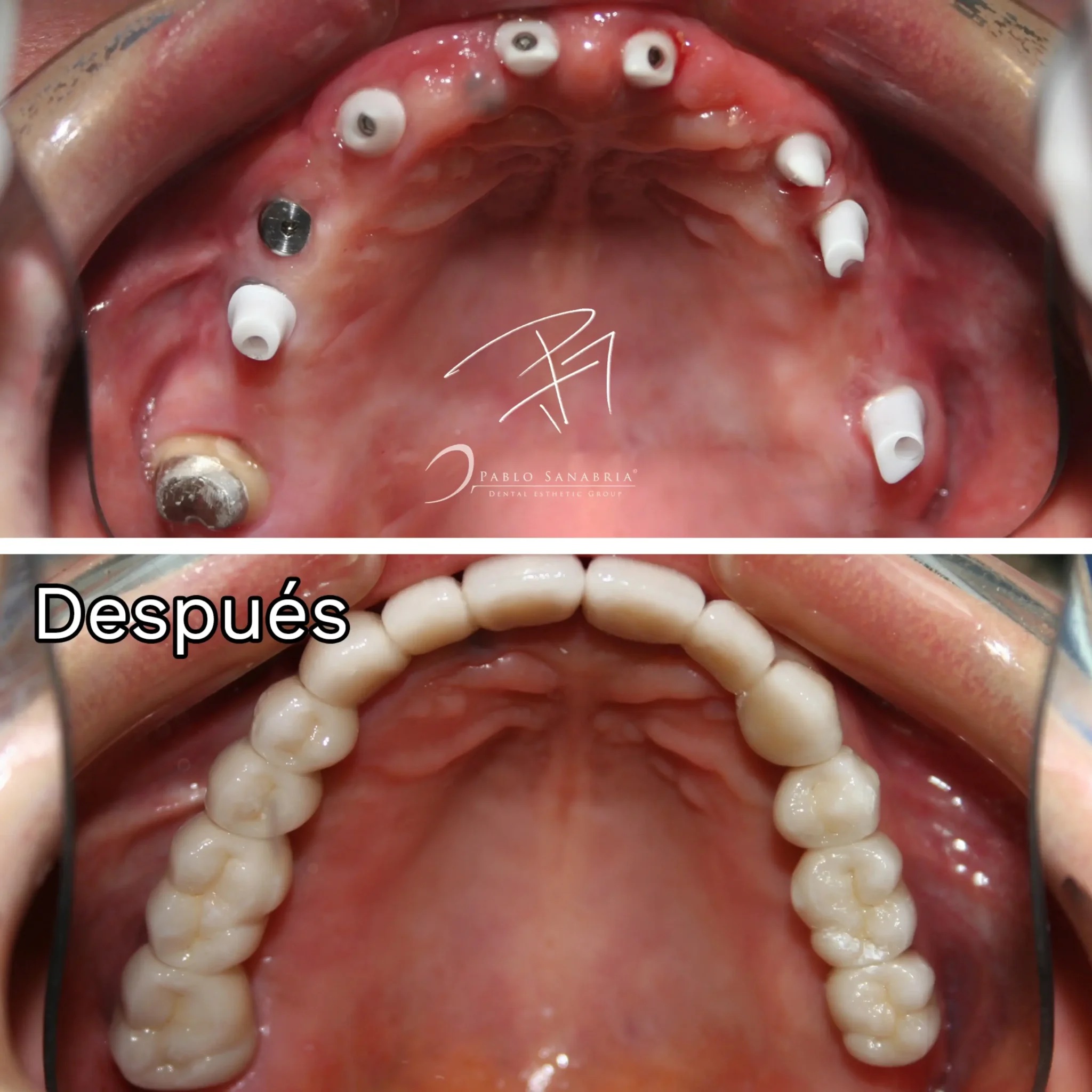 Especialista en Implantes Dentales