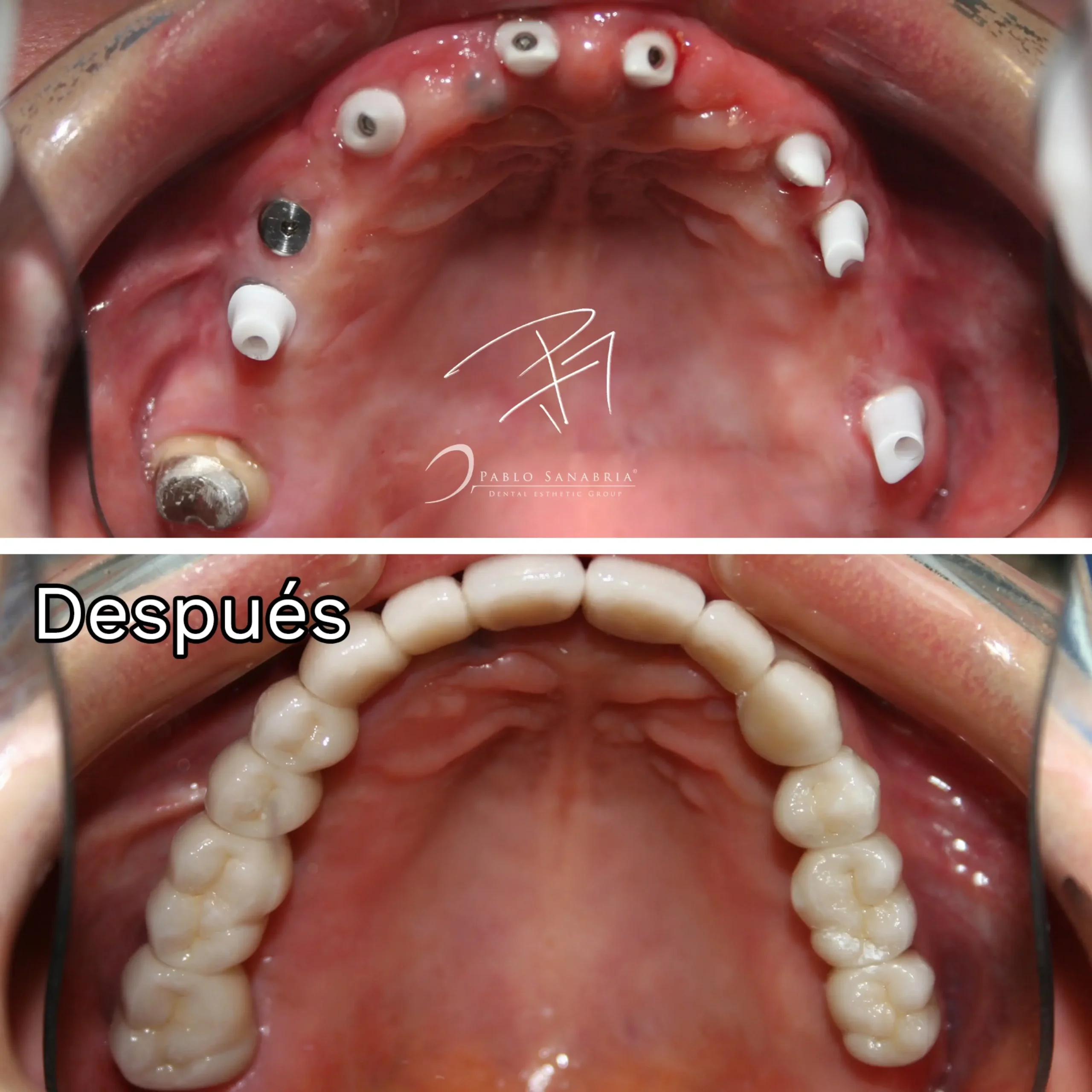 Caso implantes dentales 2
