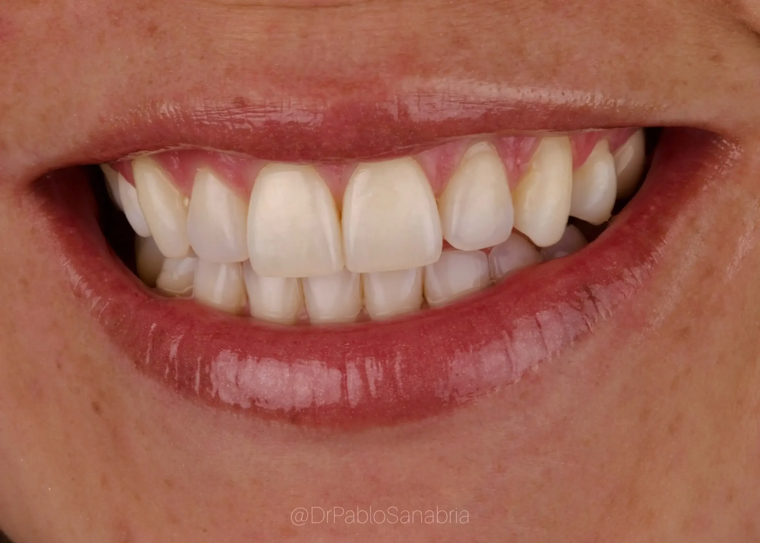 Diseño de sonrisa natural