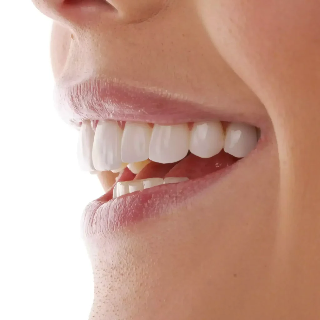 carillas dentales