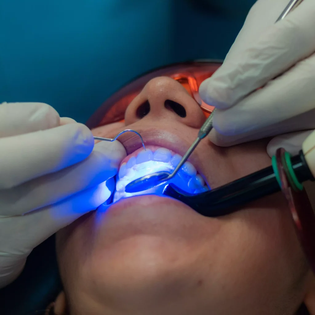 blanqueamiento dental laser