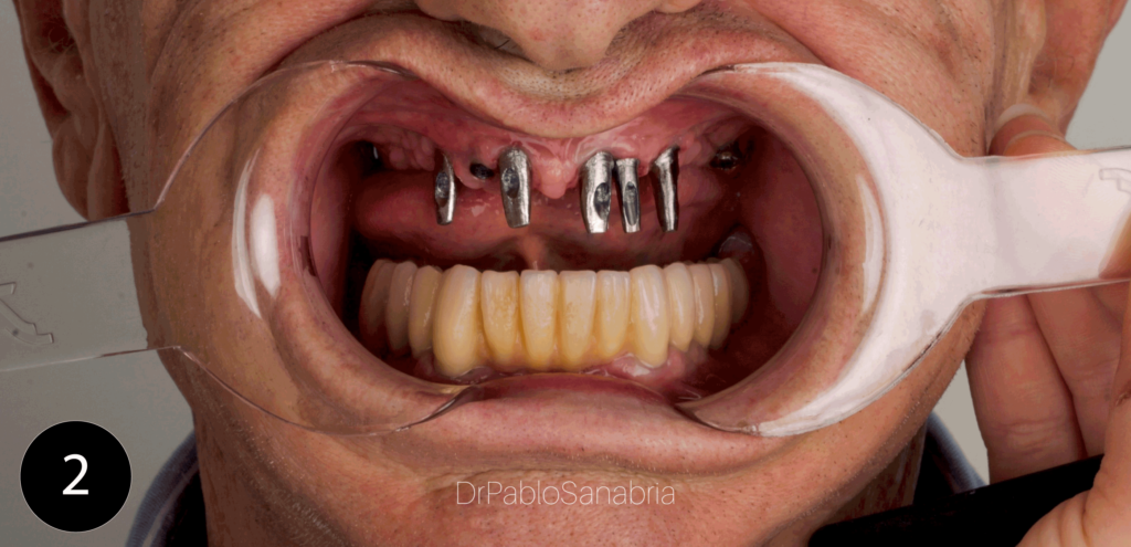 Especialista en implantes dentales