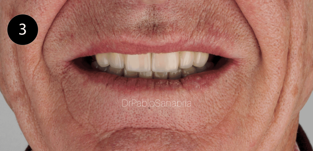 Implantes Dentales Colombia