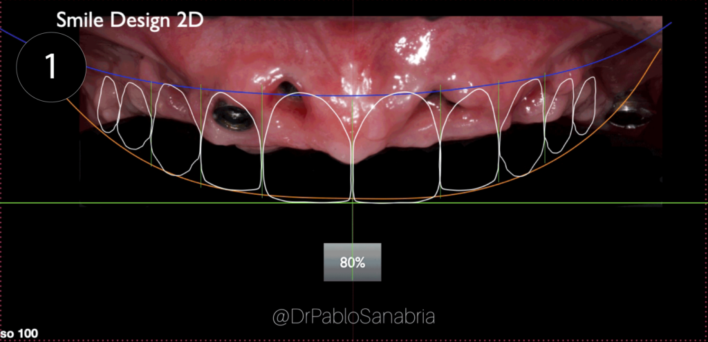 implantes dentales precio