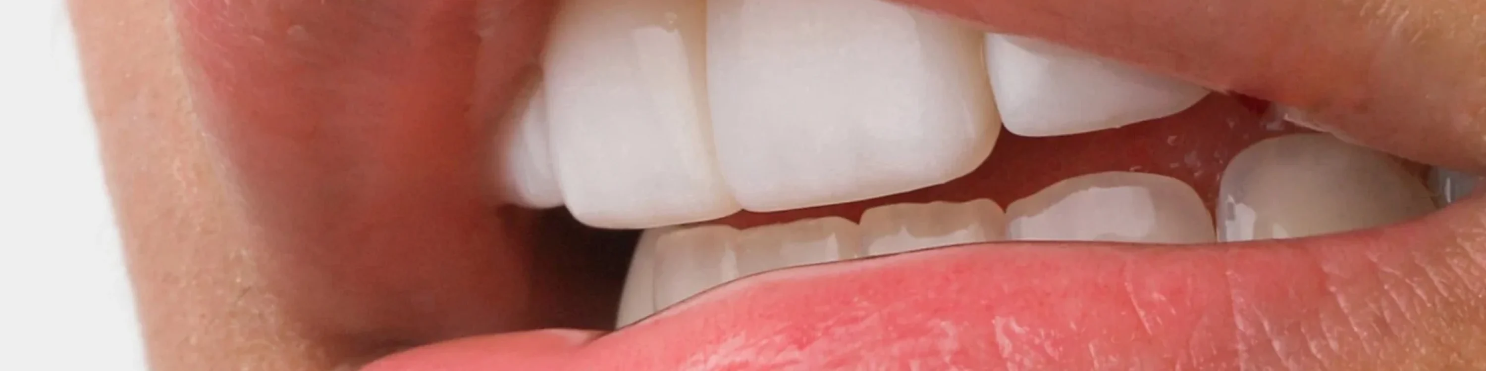 Blanqueamiento Dental