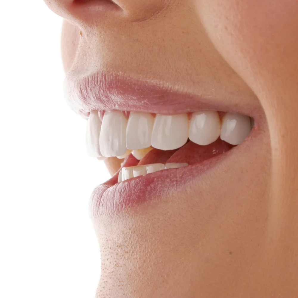 Diseño de Sonrisa Natural