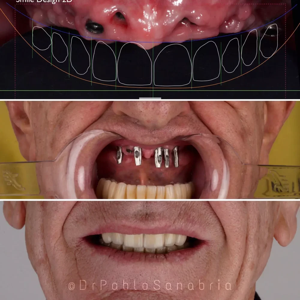 especialista en Implantes dentales