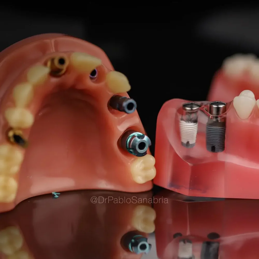 implantes dentales precio