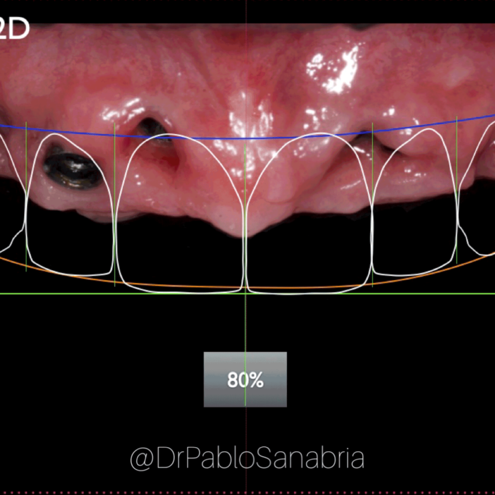 implantes dentales precio
